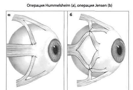 Strabismus - Operasjon