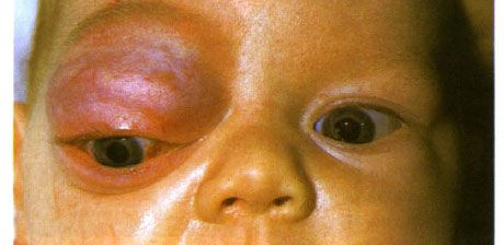 Kapillær hemangiom i den fremre delen av bane og øvre øyelokk.  Neoplasm har en tendens til å utvikle seg