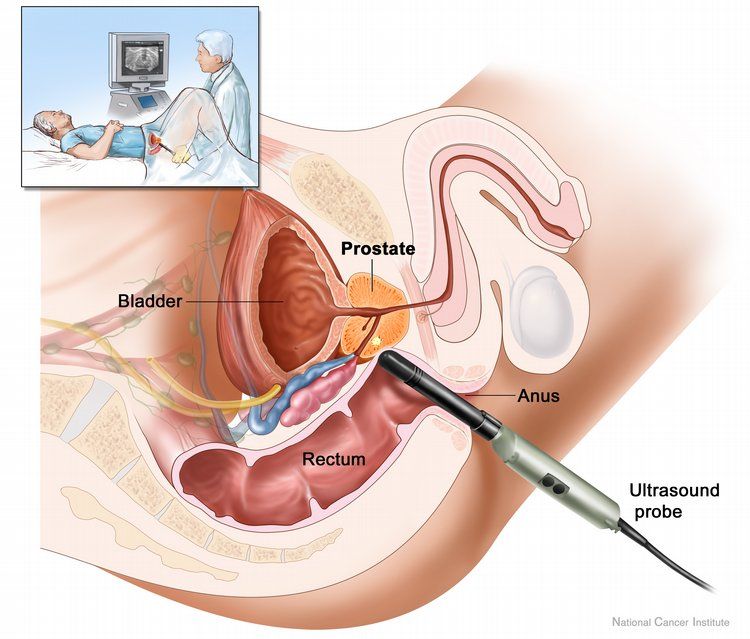 Et effektivt legemiddel mot prostatakreft er laget basert på te og gull