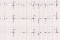 Ekg Indikasjoner Elektrokardioteknikk Normer Kompetent Om Helse Pa Ilive